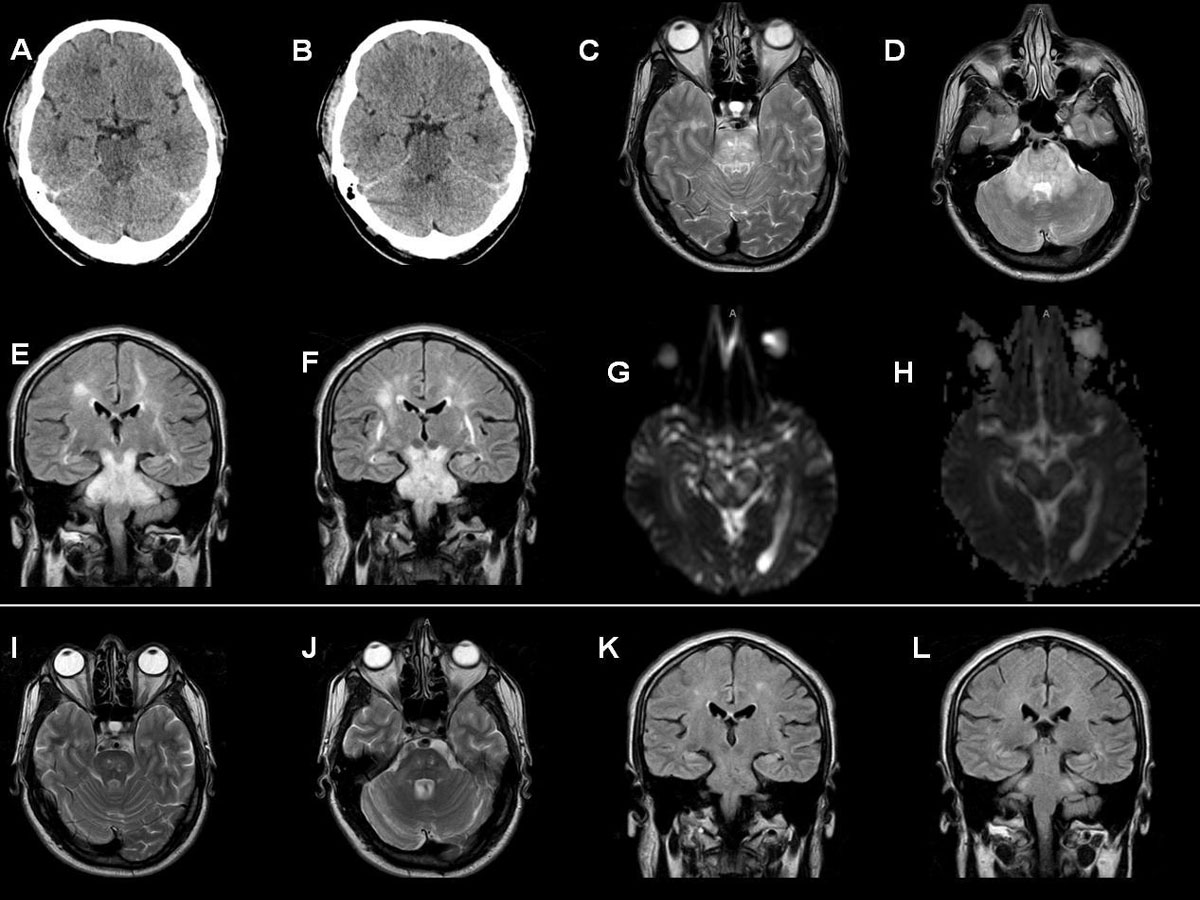 Что лучше кт головного мозга или мрт. Кт томограмма головного мозга. Компьютерная томография кт головного мозга. СКТ головного мозга снимок. Рентгеновская компьютерная томография головного мозга.