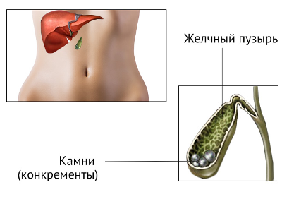 Желчнокаменная болезнь | Новости и акции Европейского медицинского центра  «УГМК-Здоровье»